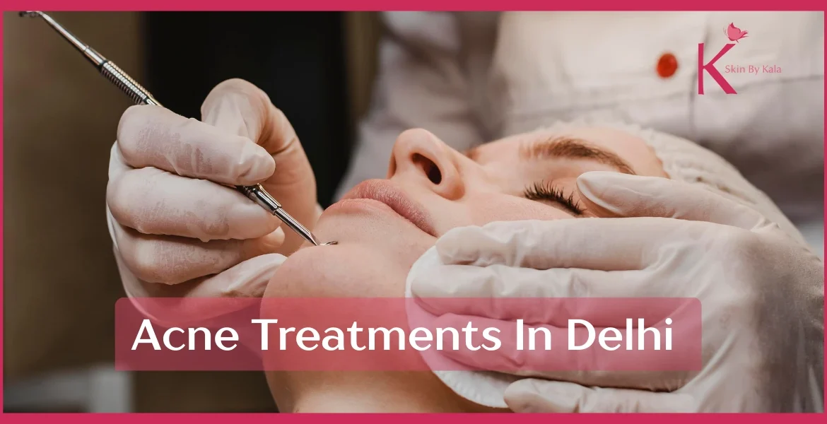 Best Acne Treatments in Delhi for Clear Skin – Acne Minimiser, Acne Reduction & Advanced Options Explained