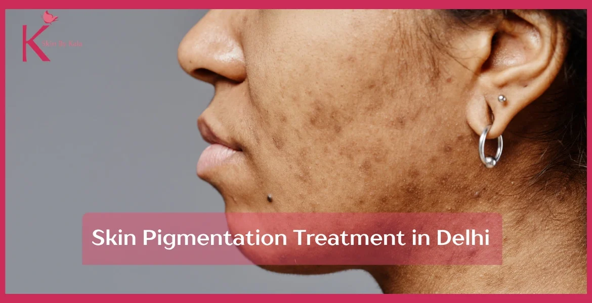 5 Proven Skin Pigmentation Treatment in Delhi | Skin By Kala, Chhartarpur