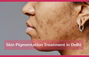Skin Pigmentation Treatment in Delhi