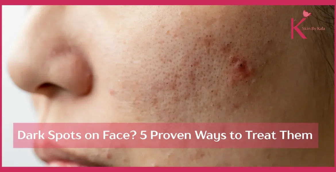 Dark Spots on Face? 5 Proven Ways to Treat Them — Complete Guide by Skin By Kala, Chhatarpur