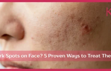 Dark Spots on Face